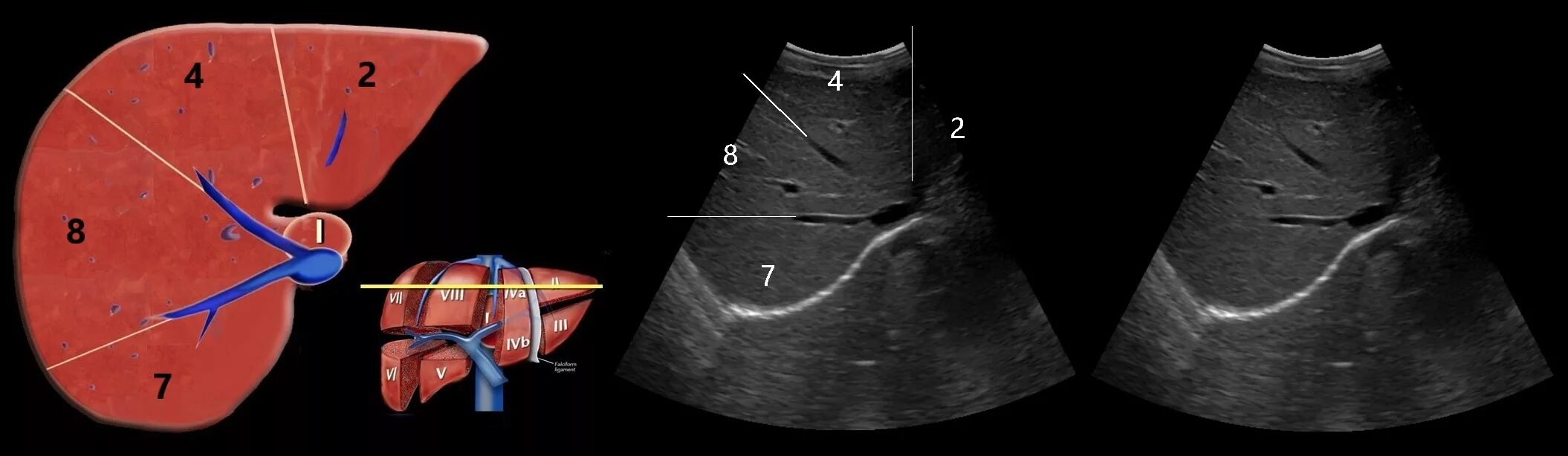 Сегментарное строение печени на УЗИ. Сегменты печени Изранов. Сегменты печени эхограмма. Сегменты печени УЗИ анатомия. Сосуды желчного пузыря