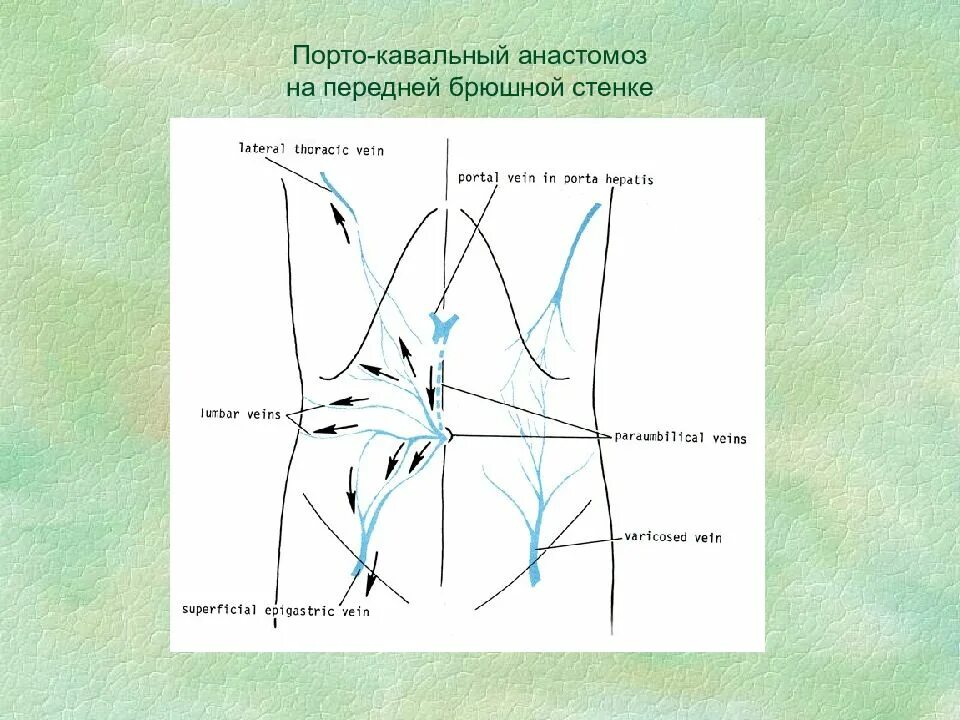 Значение кава кавальных анастомозов. Портокавальный анастомоз передней брюшной стенки. кава-кавальный венозный анастомоз. портокавальные анастомоз голова медузы. порто-кавальный анастомоз на передней брюшной стенке.