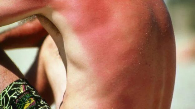 Как выглядит обгоревшая кожа this isn't happiness. Tan skin, Sunburn, Beauty