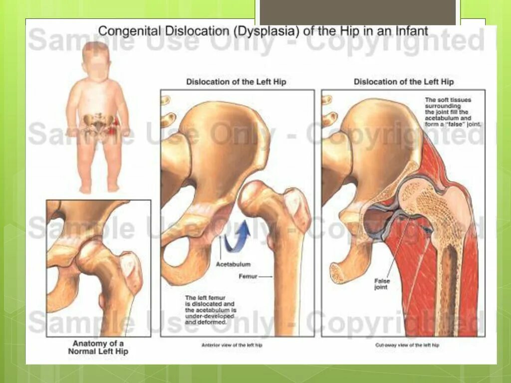 Недоразвитие тазобедренного сустава. Мкб дисплазия тазобедренных суставов детей. Дисплазия тазобедренных суставов мкб 10 у новорожденных. Дисплазия тазобедренных суставов у детей мкб 10. Эндопротезирование шейки бедра протокол операции.