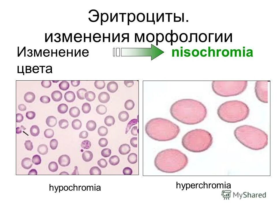 Измененные эритроциты в моче. Измененные и неизмененные эритроциты в микроскопии мочи. Клетки крови при анемии. Измененные эритроциты в крови. Эритроцитурия в моче норм.