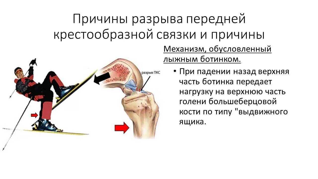 Почему территориальный разрыв. Разрыв передней крестовой связки симптомы. Симптомы повреждения крестообразной связки. Симптомы повреждения передней крестообразной связки. Причины разрыва крестообразной связки.