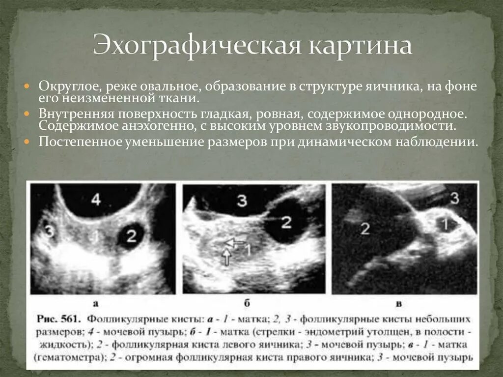 Образование округлое в яичнике