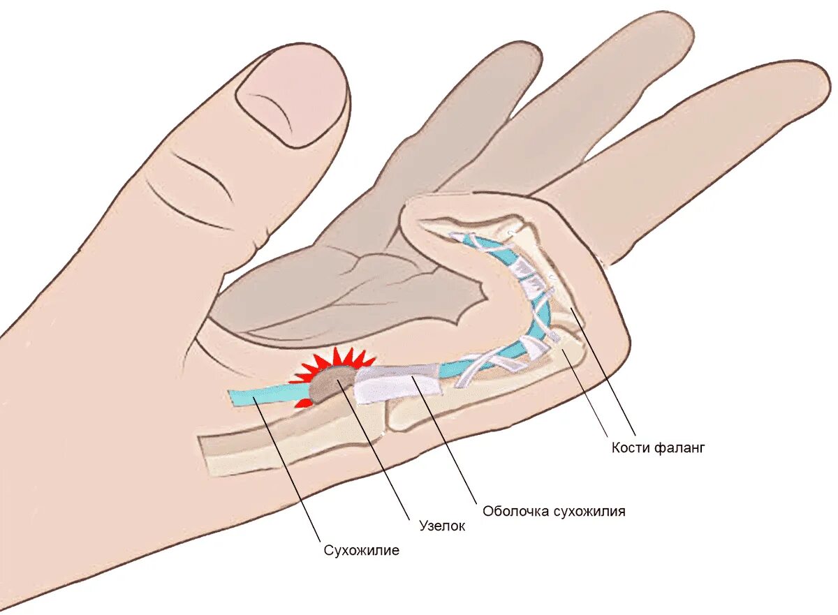 Почему тянут пальцы. Лигаментит щелкающий палец. Стенозирующий лигаментит. Болезнь Нотта мкб. Стенозирующий лигаментит де Кервена. Стенозирующий лигаментит пальца кисти мкб.