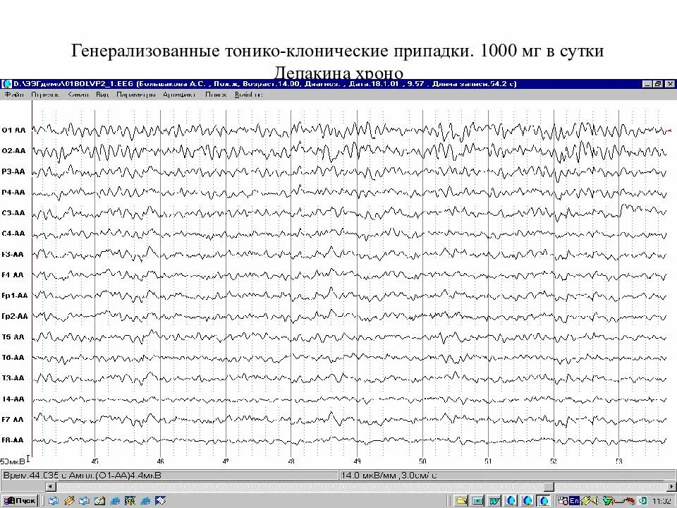 Эпилепсия тонико клоническая. Генерализованные тонико-клонические приступы ЭЭГ. ЭЭГ тонико клонические. Тонико-клонические судороги ЭЭГ. ЭЭГ при эпилепсии.