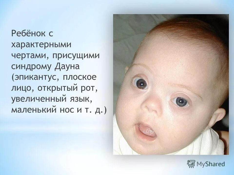 внешние проявления синдрома дауна. синдром дауна нос. синдром дауна. глаза у детей с синдромом дауна. синдром дауна строение черепа.