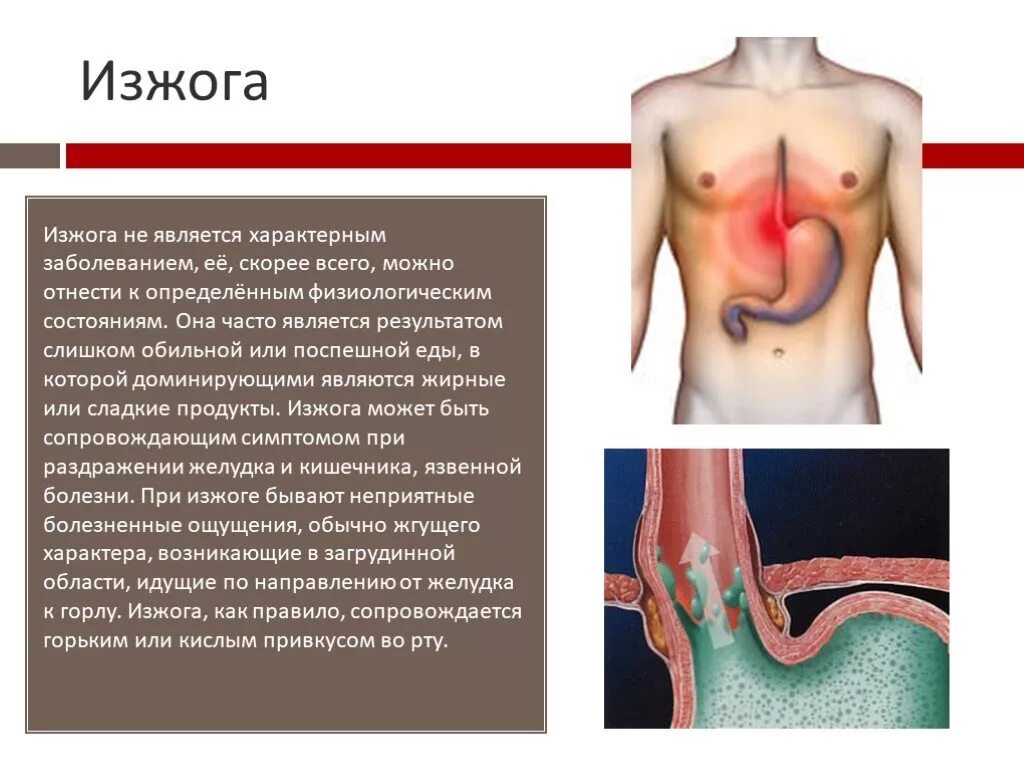 При каких заболевания изжога