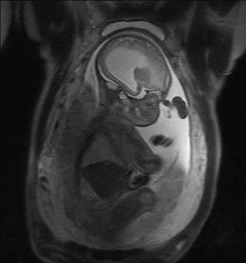 Мрт при беременности. Магнитно-резонансная пельвиометрия. Мрт внутриутробного плода. ЯМР томография плода.