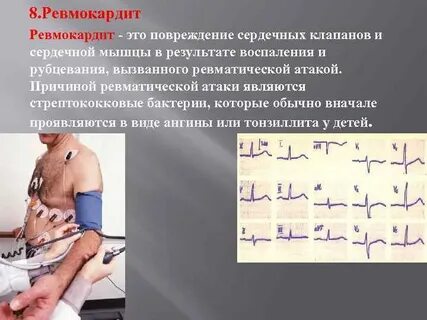 Ревмокардит