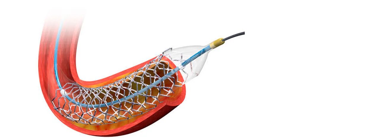 Стентов приватка. Стент Putniy. Стент Cruz коронарный.