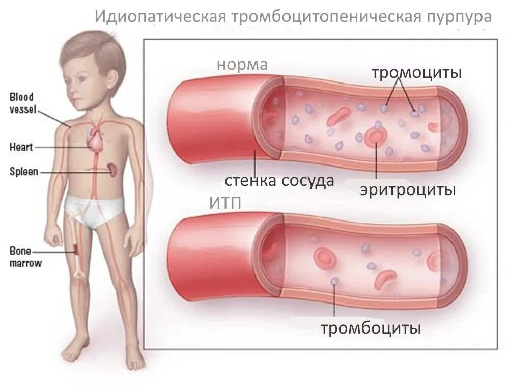 Симптомы тромбоцитопении