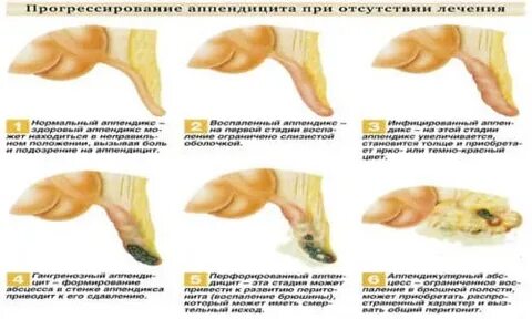 Сколько держится аппендицит