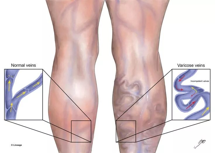 Figure 8 from Ultrasonography of the lower extremity veins: anatomy and basic ap