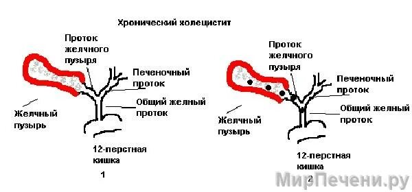 Что такое холецистит желчного. Этиопатогенез хронического холецистита. Желчный пузырь некалькулезный холецистит. Хронический калькулезный холецистит рисунок. Хронический калькулезный холецистит гистология.