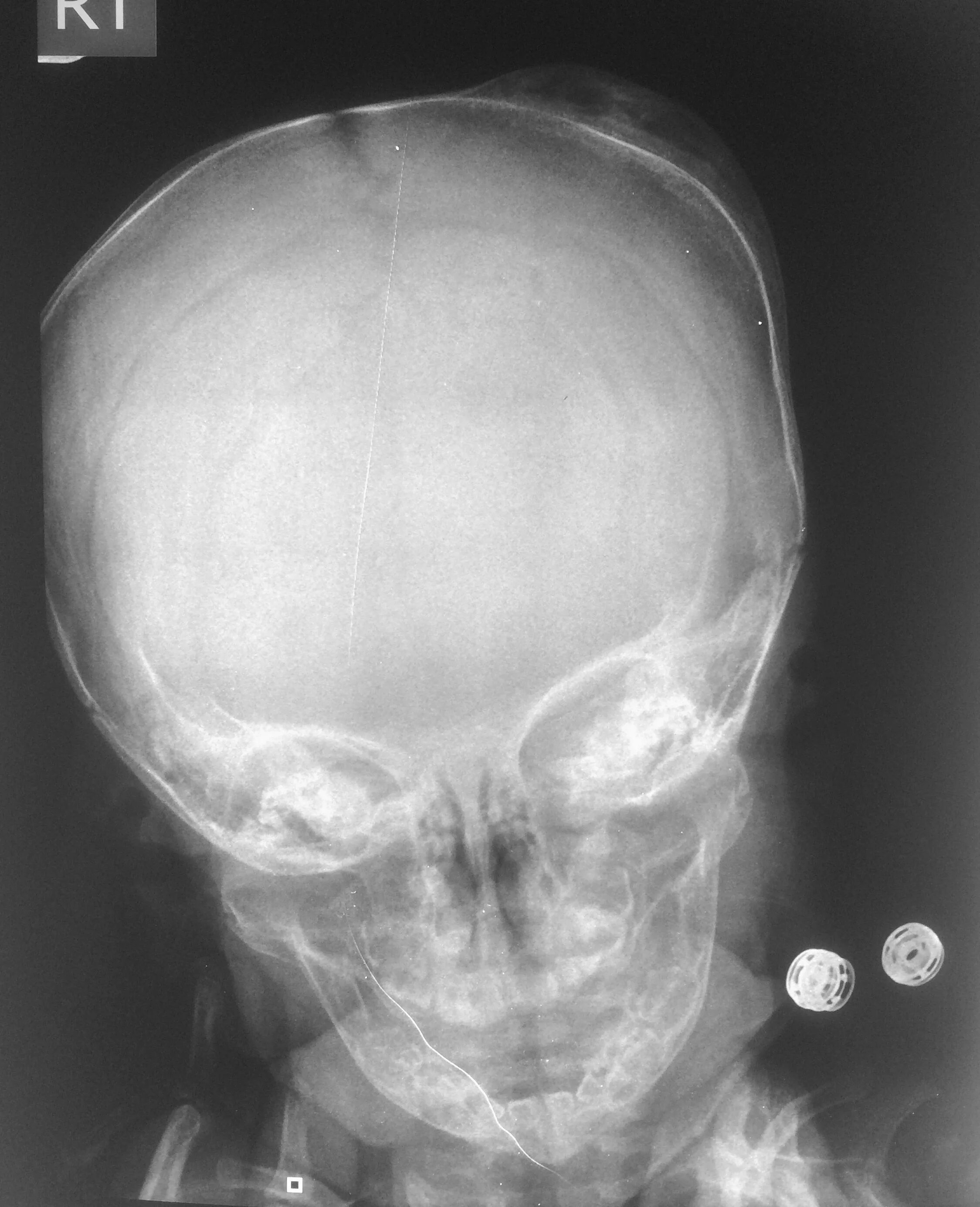 Остеома затылочной кости рентген. Остеома костей черепа рентген. Перелом теменной кости черепа рентген. Остеома лобной рентген. Трещина черепа у ребенка