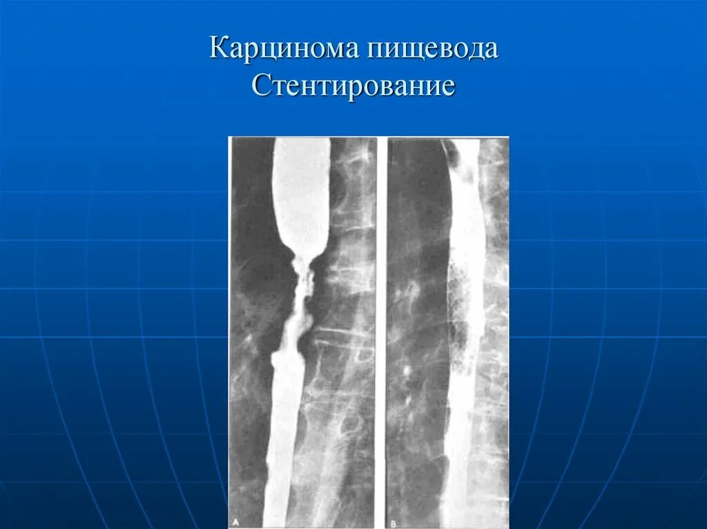 Лучевая пищевода. Саморасширяющийся стент пищевода. Стентирование пищевода. Стентирования пищевода это. Стент для пищевода онкобольных.