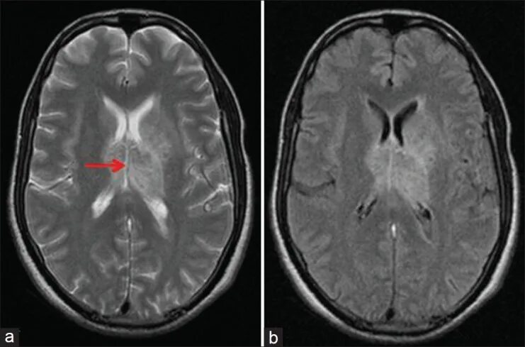 Диэнцефальный синдром. Flair MRI sequences. Bilateral subcortical n2 hyperintensity MRI. Диэнцефальные парапаги фото.