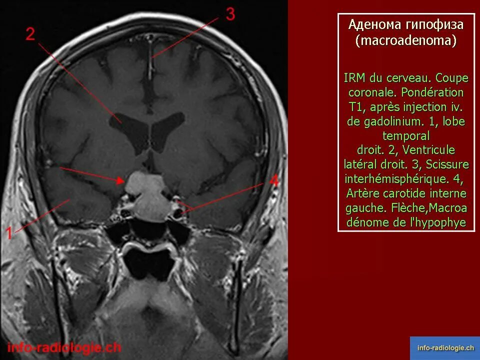 Аденома гипофиз мозга что это такое. Мрт головного мозга аденома гипофиза. Кровоизлияние в гипофиз кт. Аденома гипофиза кт. Микроаденома мрт.
