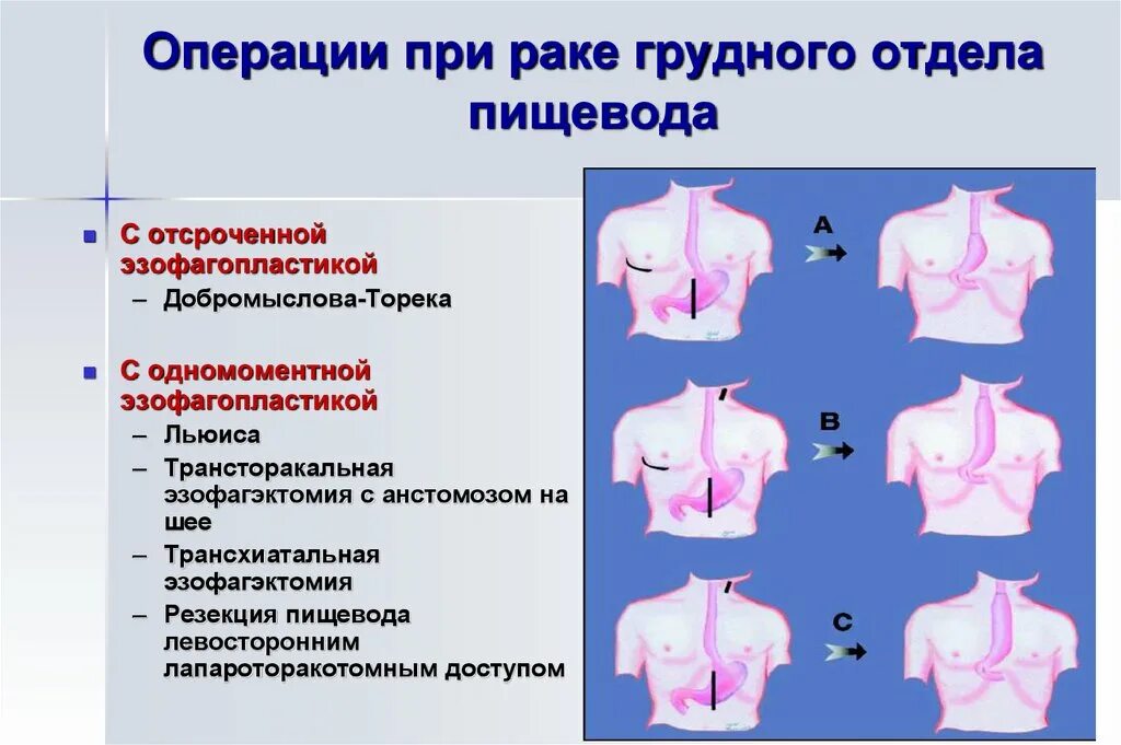  Операция Льюиса -экстирпация пищевода. Операция Добромыслова Торека. Доступы при операциях на пищеводе.