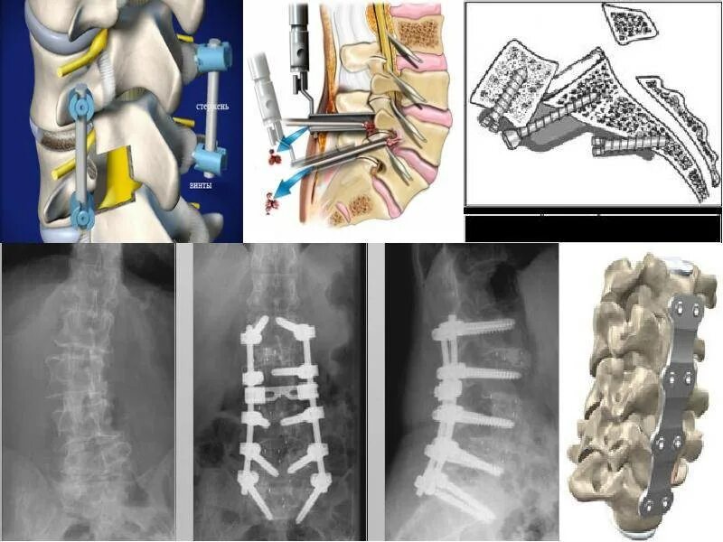 Компрессионный перелом тела т11 позвонка. Компрессионный перелом л3 л4. Компрессионный перелом позвоночника вытяжение. Компрессионный перелом позвоночника тн3. Операции на поясничном отделе позвоночника с металлоконструкцией