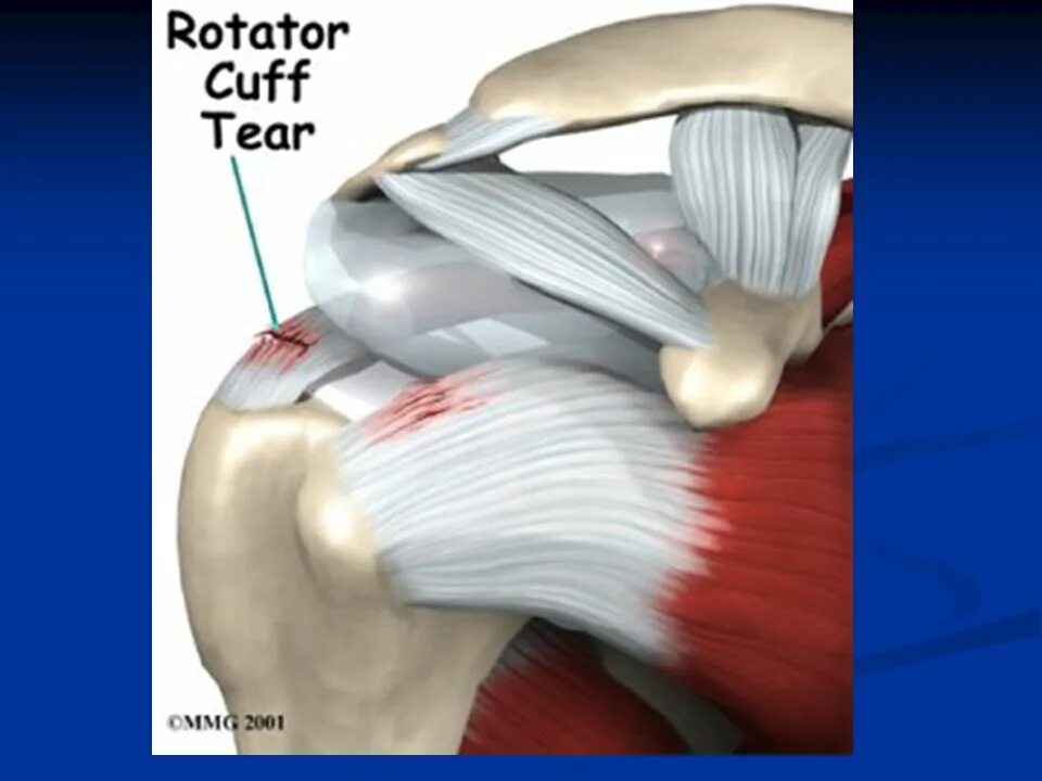 Лечение частичного разрыва мышц. Разрыв сухожилия надостной мышцы плечевого сустава. Тендинопатия сухожилия надостной мышцы. Сухожилие ротаторная манжета. Мышцы ротаторной манжеты манжеты.