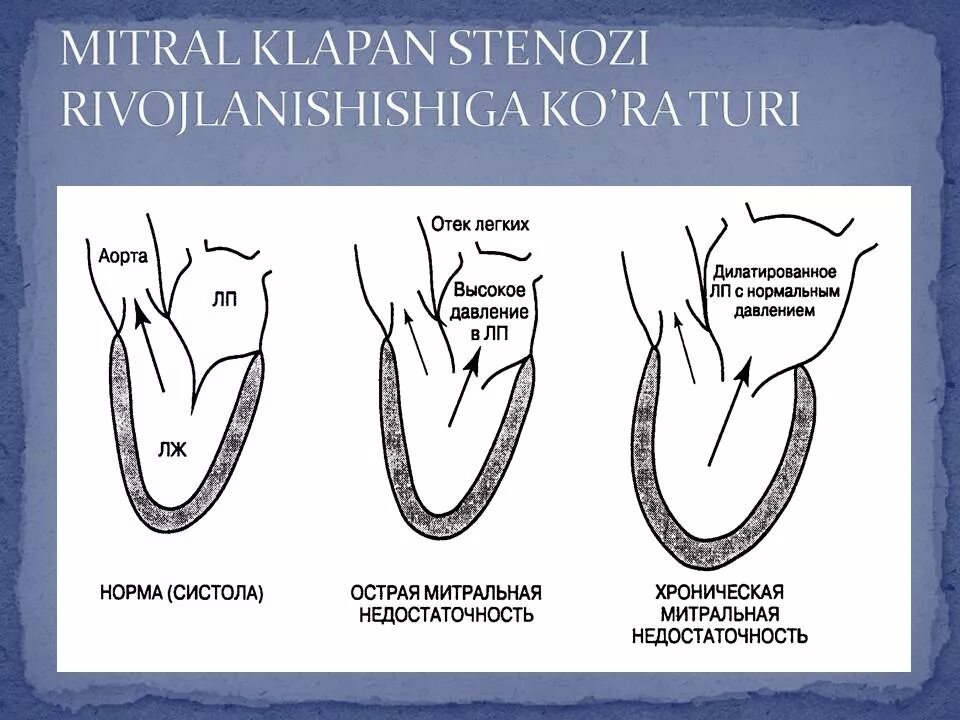 Сегменты передней створки митрального клапана. Митральная недостаточность схема. Митральная недостаточность гемодинамика схема. Недостаточность митрального клапана.