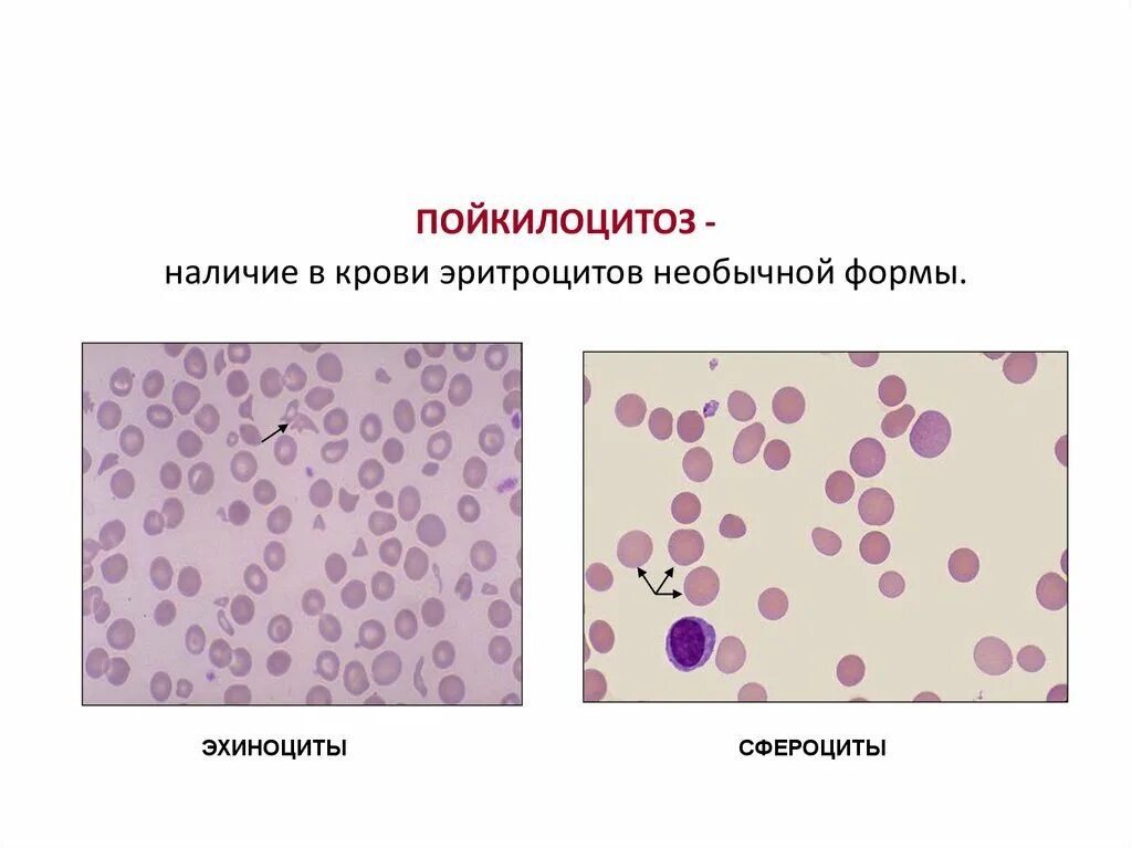 Пойкилоцитоз формы эритроцитов. Эхиноциты анемия. Пойкилоцитоз эхиноциты. Эритроциты форма сфероцит.