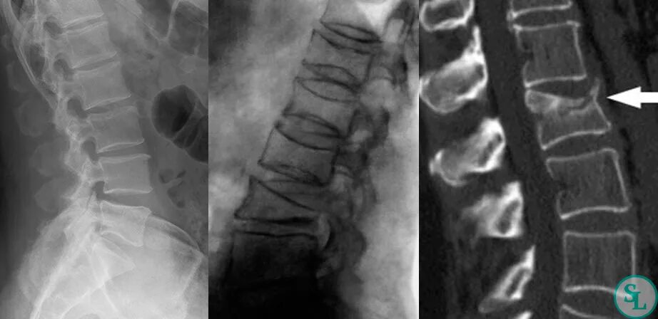 Перелом с7 позвонка рентген. Остеопороз компрессионный перелом позвоночника. Компрессионный перелом позвоночника th7. Компрессионный перелом l1 рентгена.