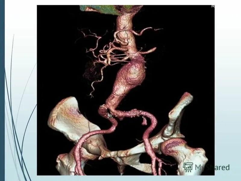 кт брюшной аорты и нижних конечностей. аневризма брюшной аорты кт ангиография. атеросклероз брюшной аорты кт. мультисрезовая компьютерная томография (мскт). ангиография кт сосудов нижних нижних конечностей.