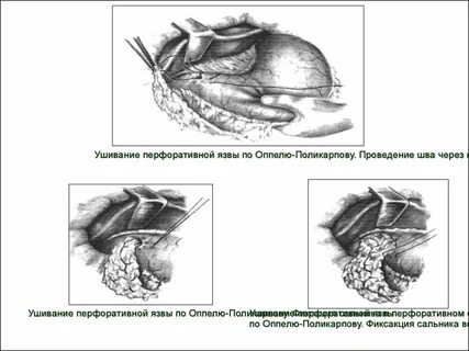 Перфорация язвы двенадцатиперстной