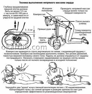 Смещение грудины при массаже сердца