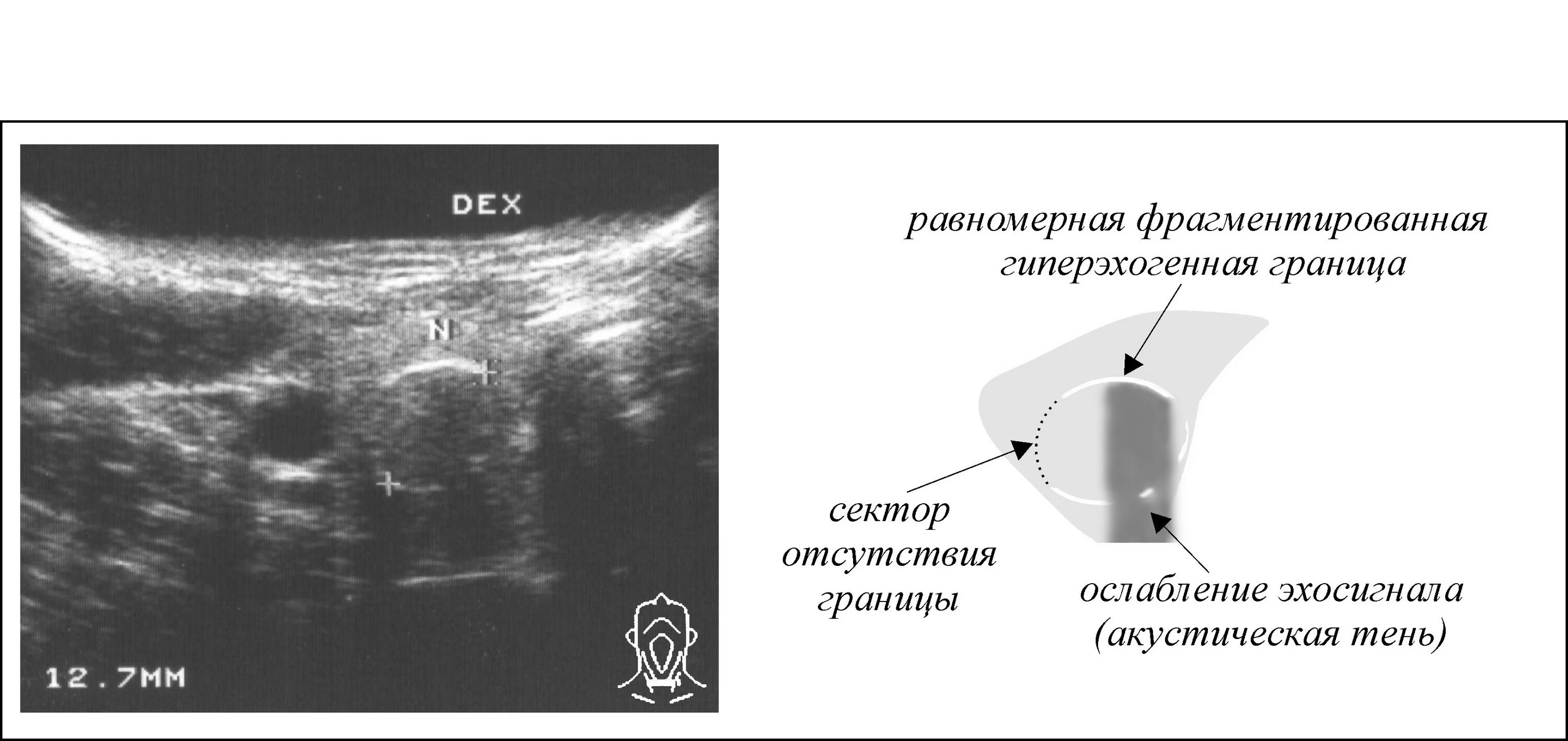 Образование без акустической тени. Гиперэхогенный узел в щитовидной железе. Гиперэхогенное образование в щитовидной железе. Изоэхогенное образование. Гиперэхогенное образование с акустической тенью.