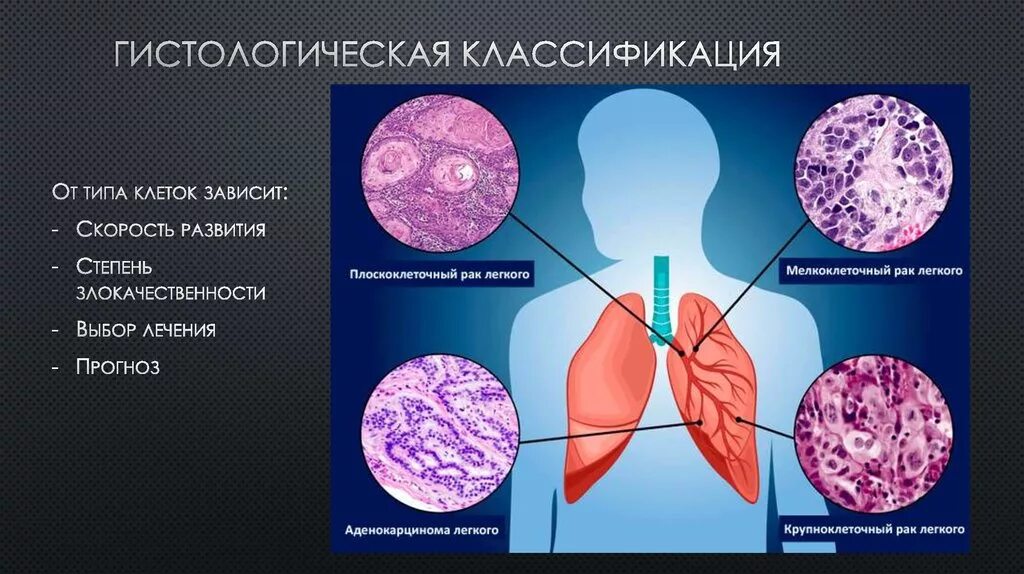 Лечение опухолей легкого. Плоскоклеточная карцинома легкого гистология. Опухоли легких классификация. Стадии онкологии легкого. Раковые клетки в легочной ткани.