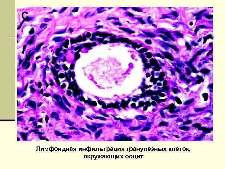 Лимфоплазмоцитарная инфильтрация стромы. Лимфоплазмоцитарная инфильтрация стромы