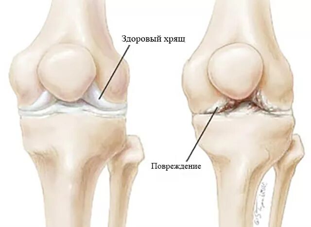 Изменения в коленных суставах. Периартрит коленного сустава симптомы. Периартрит коленного сустава рентген. Надколенник коленного сустава. Воспаления коленных сухожилий (периартрита сумки «гусиной лапки»).