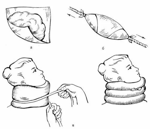 Шина при травме головы. Ватно-марлевого воротника типа Шанца. Ватно-марлевый воротник Шанца. Техника иммобилизации воротником Шанца. Иммобилизация шеи воротником Шанца.