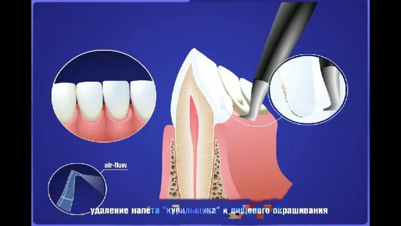 Где можно удалить зуб по полису. Этапы профессиональной гигиены полости рта. профилактика зубного камня.