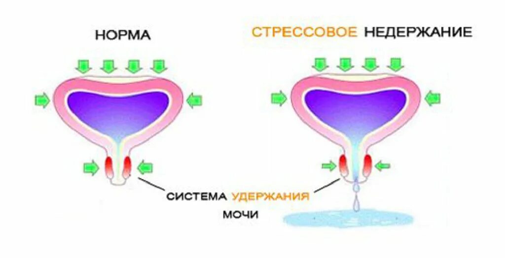 При кашле мочеиспускание у женщины. Недержание мочи. Стрессовое недержание мочи. Стрессовое недержание мочи причины. Недержание мочи у женщин.