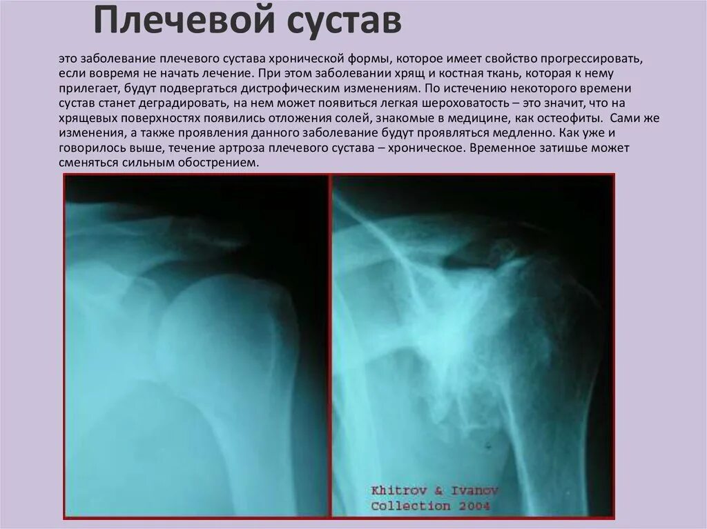 Диагноз доа суставов. Деформирующий артроз плечевого сустава рентген. Деформирующий артроз плечевого сустава рентген степени. Деформирующий остеоартроз плечевого сустава рентген. Ревматоидный артрит плечевого сустава рентген.