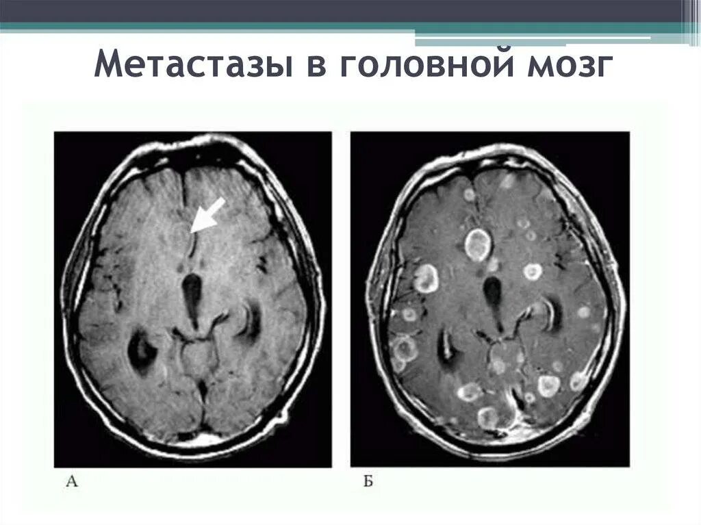 Метастазы меланомы в головной мозг кт. Метастатические опухоли головного мозга. Множественные метастазы в головной мозг. Метастатическое поражение головного мозга.