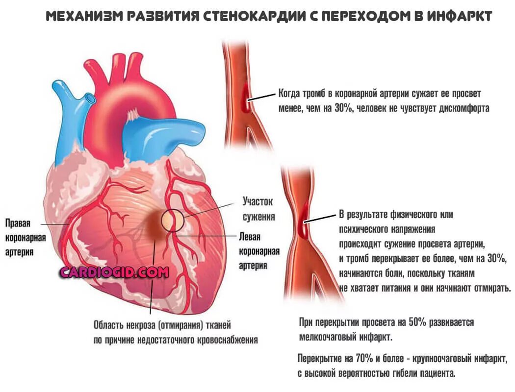 Сильное сердце что делать. Ишемическая болезнь сердца стенокардия. Сердце при нестабильная стенокардия. Стенокардия напряжения механизм возникновения. Стенокардия картинки.
