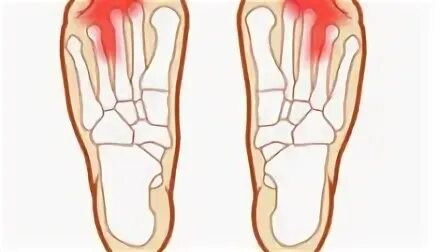 Почему болит палец на правой ноге