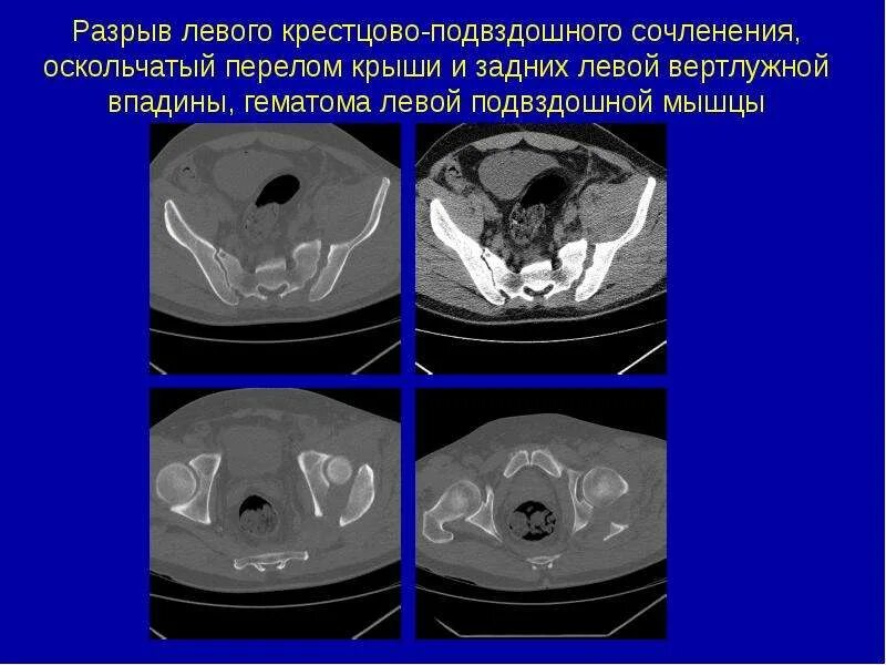 Разрыв крестцово подвздошного сочленения. Разрыв крестцово подвздошных. перелом крестцово подвздошного сочленения. отрыв крестцово-подвздошных сочленений. кт разрыв крестцово-подвздошного сочленения.