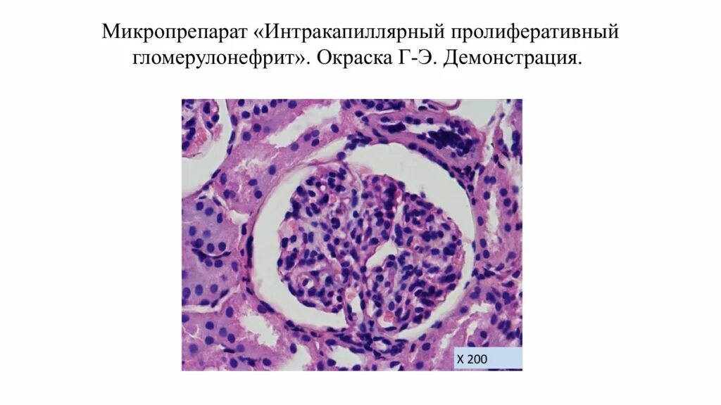 Интракапиллярный гломерулонефрит. Хронический экстракапиллярный гломерулонефрит. быстропрогрессирующий гломерулонефрит микропрепарат. интракапиллярный пролиферативный гломерулонефрит. подострый экстракапиллярный продуктивный гломерулонефрит.