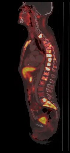 ПЭТ кт с РФП 18. Накопление 252 % РФП ПЭТ кт. ПЭТ-кт множественные метастазы. Рфп при пэт кт