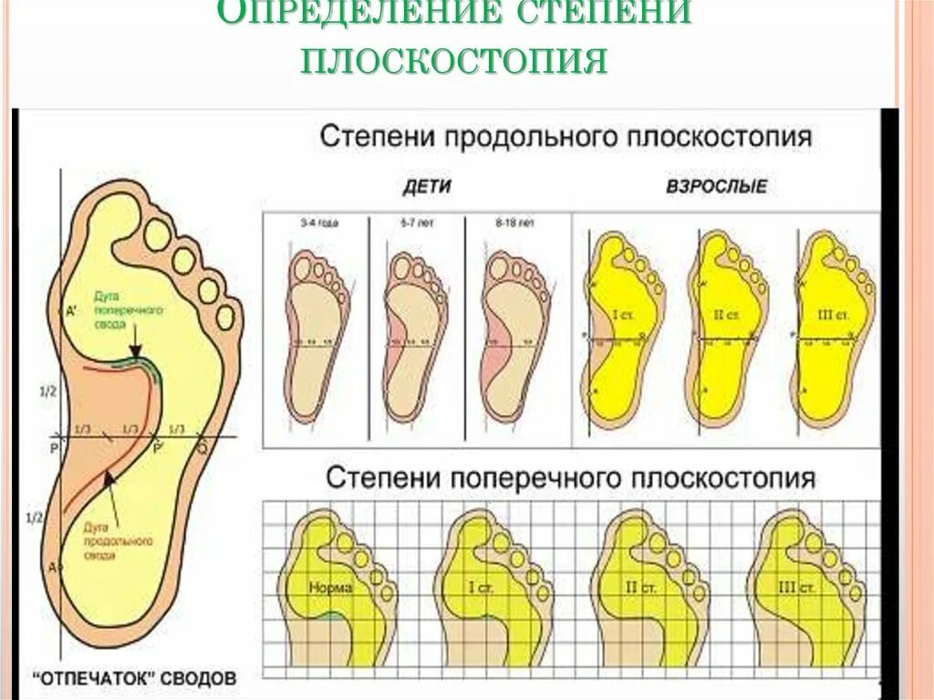 Поперечное и продольное плоскостопие классификация. Плоскостопие травматические повреждения. Классификация степеней продольного плоскостопия. Продольное плоскостопие этиология. Продольный поперечный свод