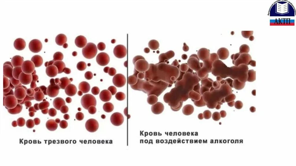 Кровь человека под микроскопом. Густая кровь и нормальная. Кровь трезвого человека кровь пьющего человека.