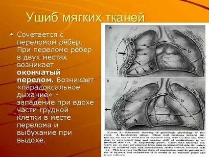Ушибла мягкую ткань