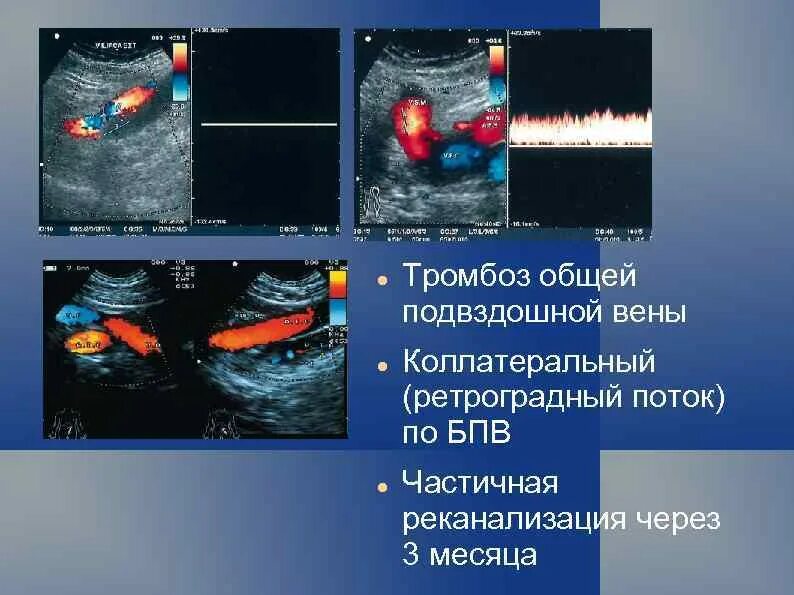 Тромбоз бпв. Тромбоз вен нижних конечностей УЗИ. Тромбофлебит ультразвуковое дуплексное ангиосканирование.. Тромбоз вены УЗИ реканализация. Тромбоз глубоких вен нижних конечностей на УЗИ.