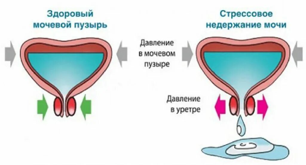 Почему происходит недержание. Недержание мочи мочевой пузырь. Ургентное недержание мочи. Стрессовое недержание мочи.